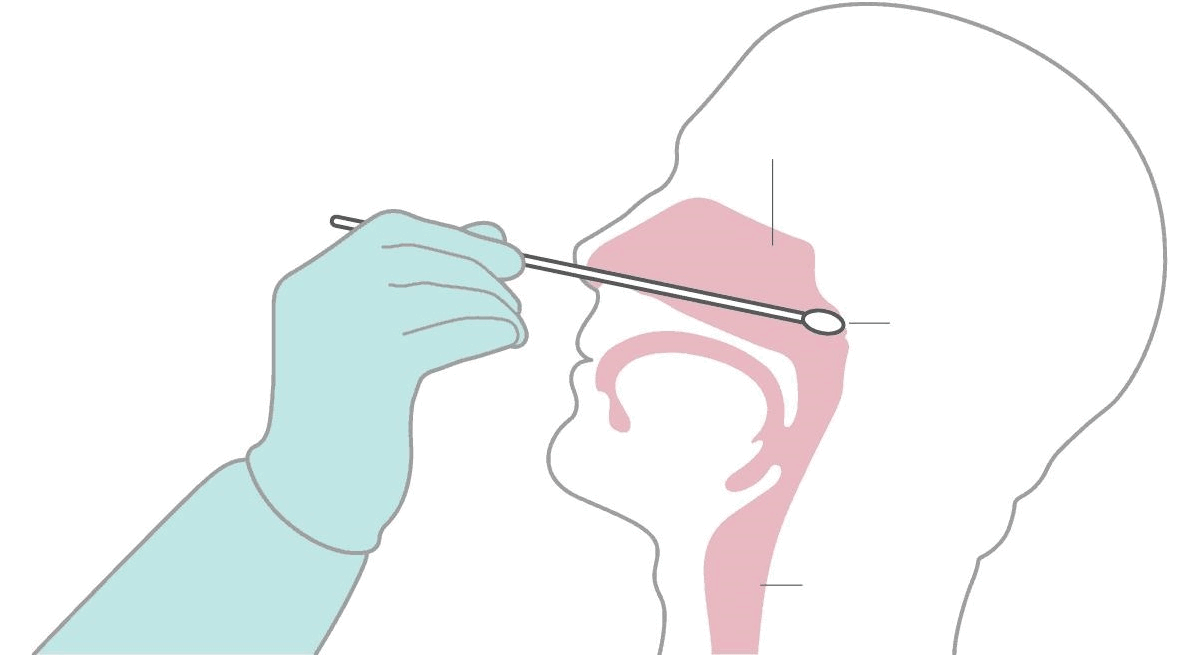 咽拭子如何提取病毒的其他样本吗